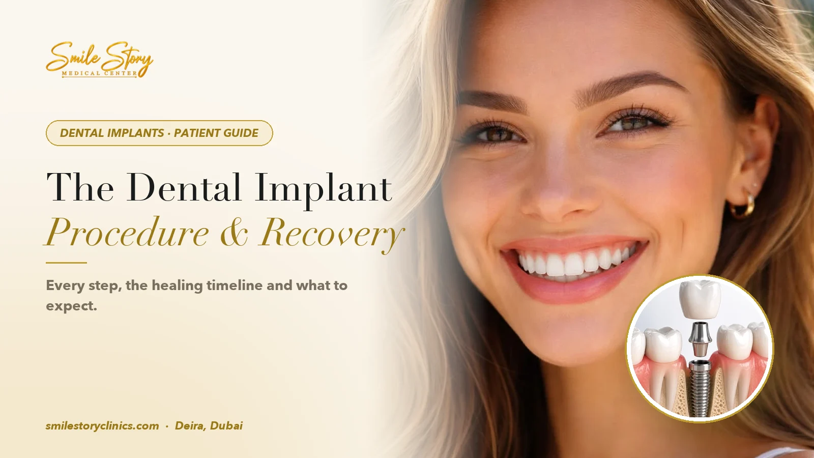 The Dental Implant Procedure: Steps, Healing Time and Recovery | Smile Story Medical Center, Deira