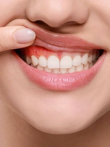 Healthy gums and teeth after gum disease treatment